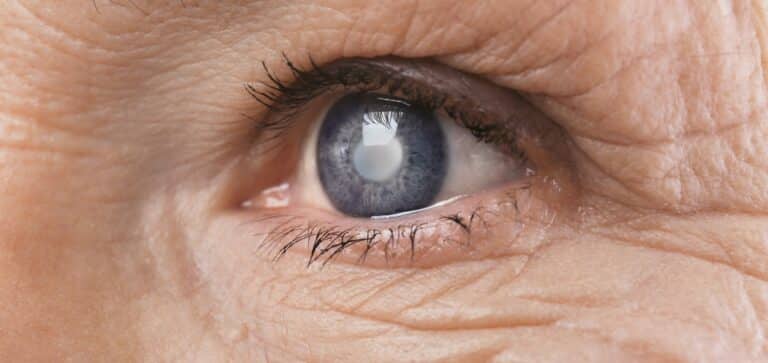 Cataract senior woman's eye closeup