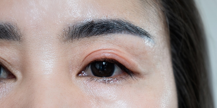 Eyelid Malpositions
